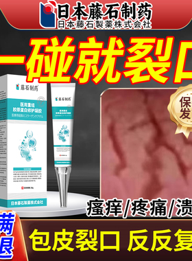 包皮炎症专用红肿开裂口发炎真菌感染白垢干破裂开龟头炎OM