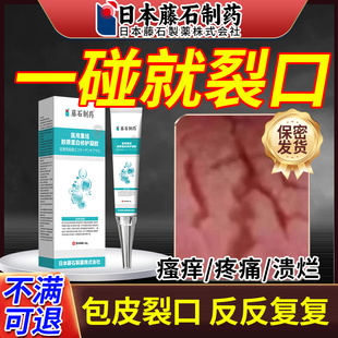 包皮炎癥專用紅腫開裂口發炎真菌感染白垢干破裂開龜頭炎OM