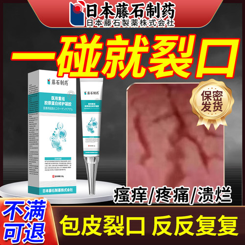 包皮炎症专用红肿开裂口发炎真菌感染白垢干破裂龟头炎药房同售OM