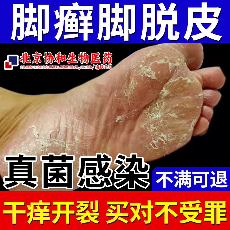 足脚癣一次净官方旗舰店脚气止痒裂脱皮真菌感染膏药om