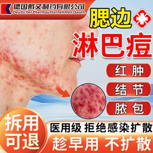 淋巴痘腮边痘下巴反复长痤疮去脖子脸颊两边长痘痘消除结节硬块FJ