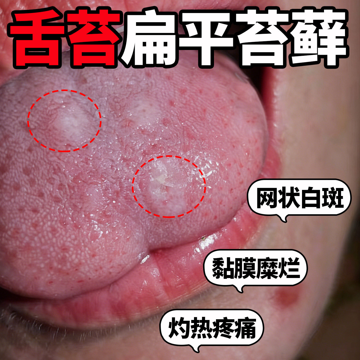 口腔扁平苔藓喷剂舌头糜烂黏膜白斑溃疡纤维化专用修复液搭牙膏OM