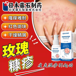 玫瑰糠疹专用湿毒清软膏皮肤瘙痒红斑疹鳞屑晒伤止痒可搭膏药贴HB