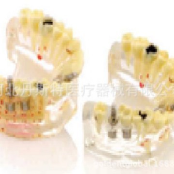 牙齿种植教学实训模型