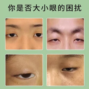 极速大小眼矫正器上眼睑皮松w弛下垂提拉紧致肉眼泡撑双眼皮美肤