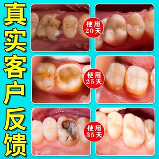 极速牙齿去黑线黑渍牙窝沟专用牙膏成人儿K童防龋齿蛀牙修复牙发