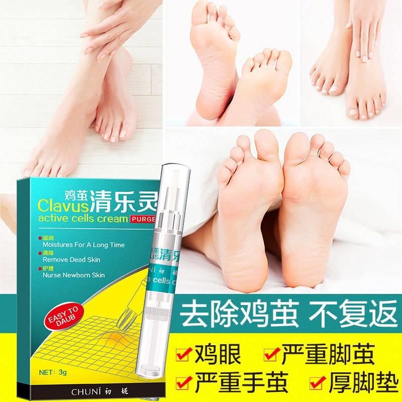 买二送一)初妮鸡茧清乐灵鸡茧净除茧膏脚底去茧神器手部去死肉茧