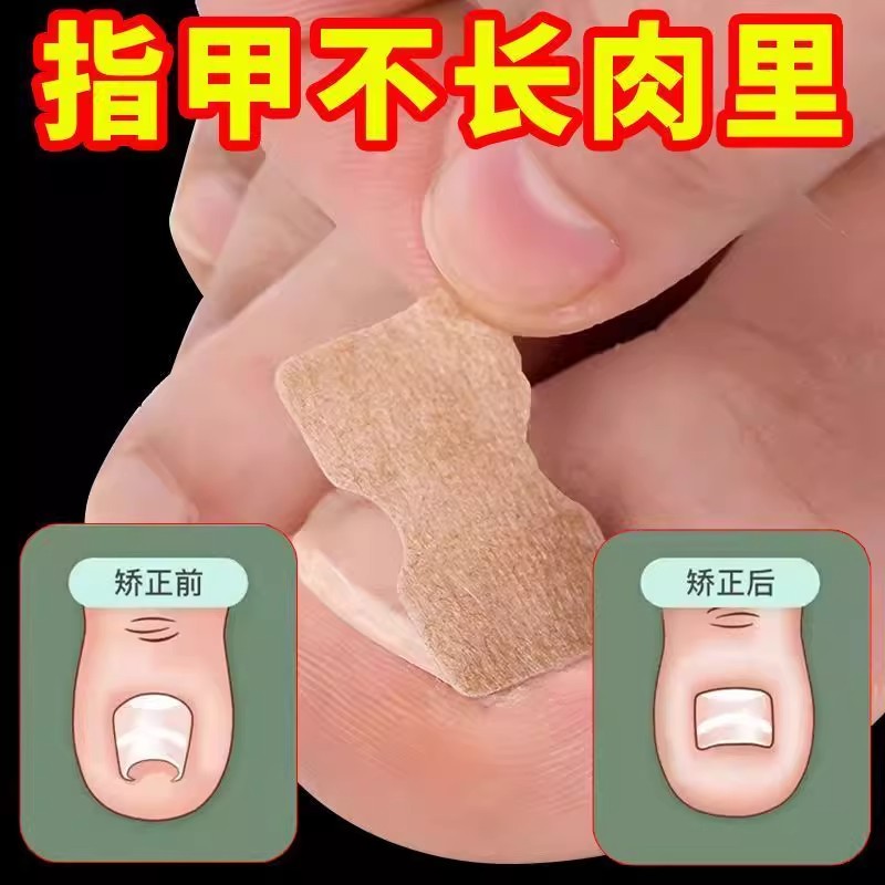 甲沟炎矫正贴免胶水嵌甲正甲贴