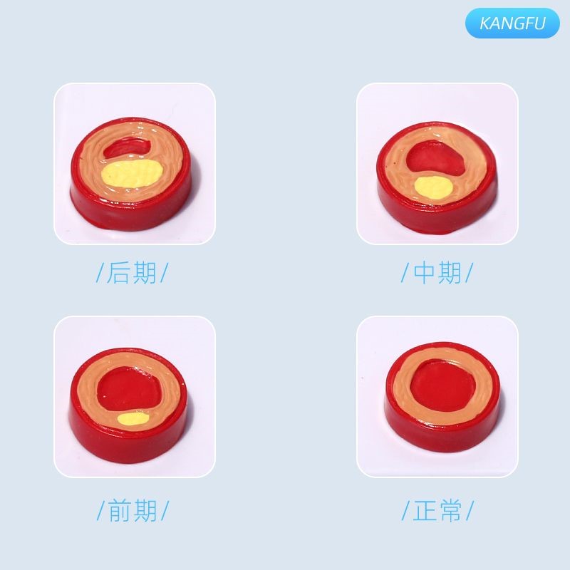 血管/堵塞动支脉粥样/硬化心血管动脉/硬化模型血管病理模型血栓