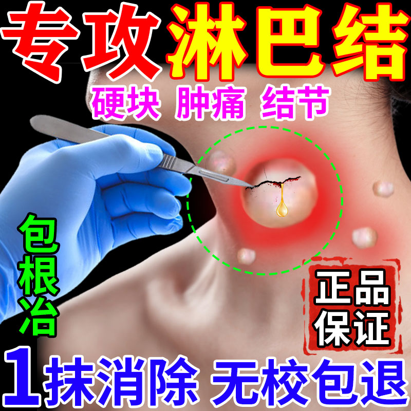 新品淋巴结消散膏淋巴结肿大脖子耳后腋窝去副乳疏通神器淋巴散结