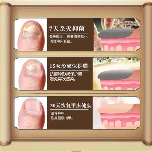 极速脚指甲发黄变厚坏指甲增厚脚趾甲黄黑白空甲修复甲分离灰甲神