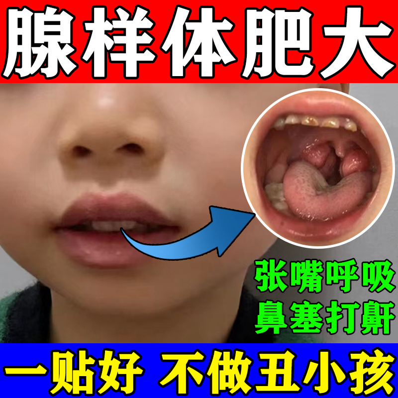 网红儿童腺体样肥大面容矫正器小孩嘴突防张嘴呼吸睡觉打呼噜中药