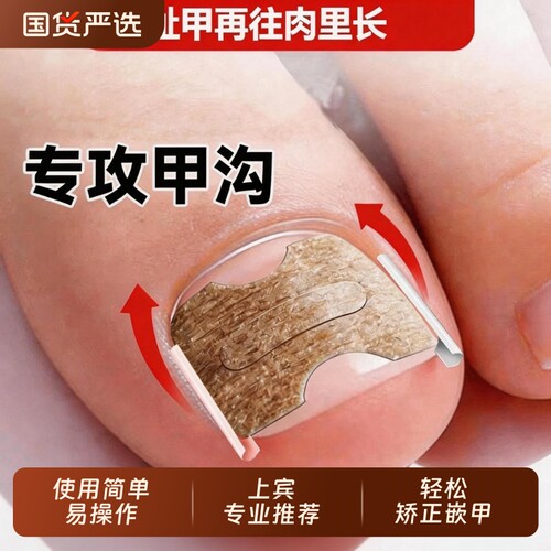 脚趾矫正器矫正嵌甲|千人加购