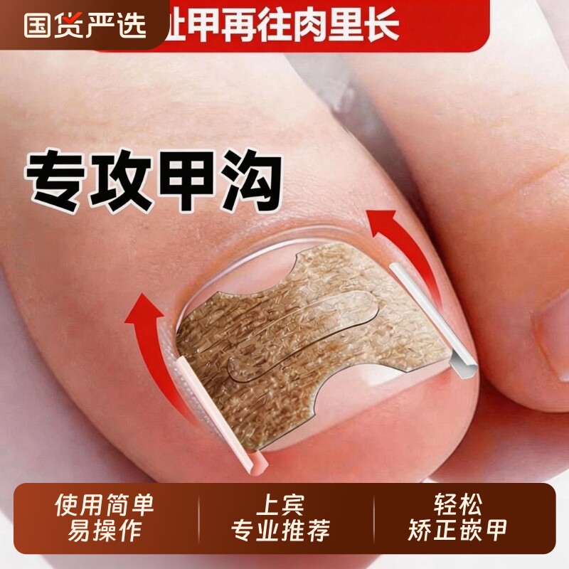 甲沟矫正器脚指甲往肉里长专用正甲贴片嵌甲矫正趾甲扎肉工具专业