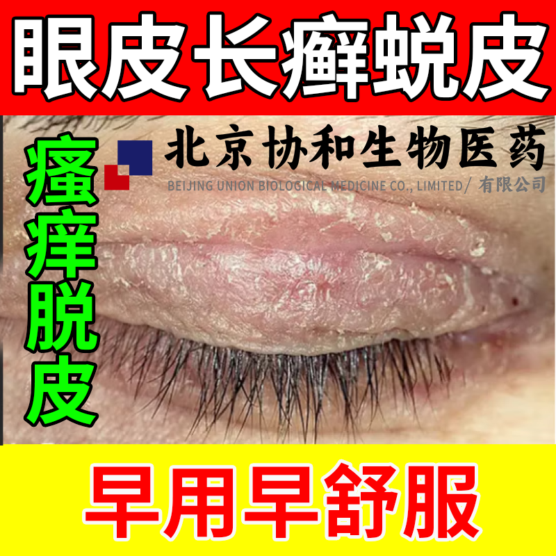 眼皮癣湿疹脸上长癣去眼睛角周围痒干燥瘙痒根可搭配止痒膏贴rj