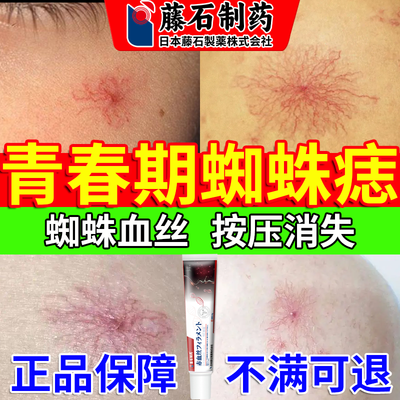 青春期蜘蛛痣血管瘤血管痣搭配去除药膏青少年点红痣毛细血管瘤rj