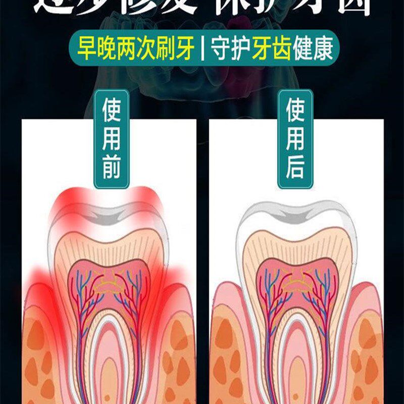 极速牙齿松动牙膏治牙周炎牙龈肿痛萎缩牙痛咀嚼无力固齿牙齿晃动