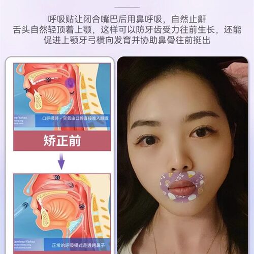 极速矫正】口呼i吸矫正贴封口器闭嘴神器睡觉防张嘴封嘴唇闭合儿