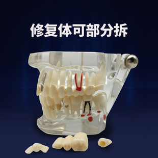 极速牙科教学牙模义齿全口牙v齿模型标准模型排龈练习齿科成人口