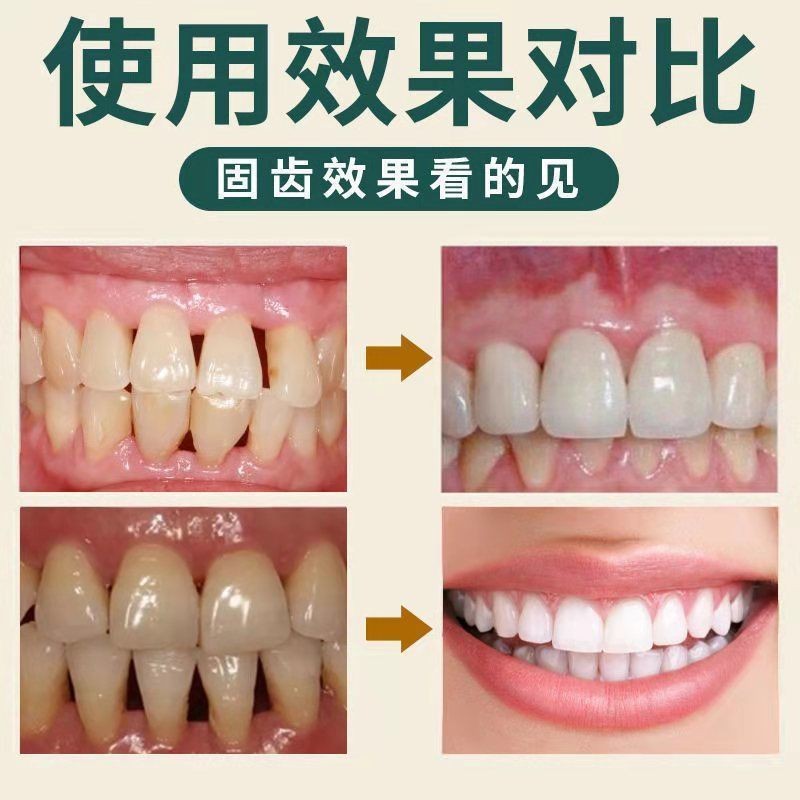 极速10万牙松患i者】牙齿松动固齿牙膏牙龈肿痛出血再生护龈固齿J