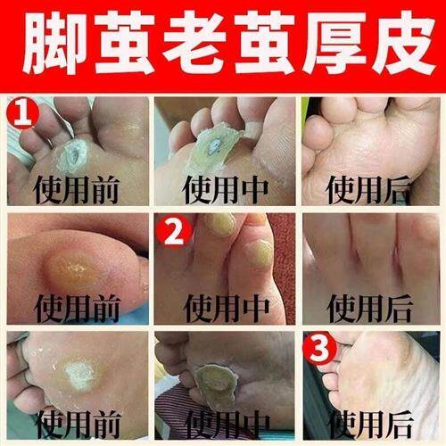 极速老茧去除脚茧软化剂小脚趾胼C胝膏治脚垫的药祛脚底硬死皮神