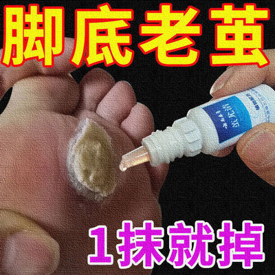 极速去脚老茧死皮软化剂去除手上老茧硬J皮脚茧软化脚趾头关节茧