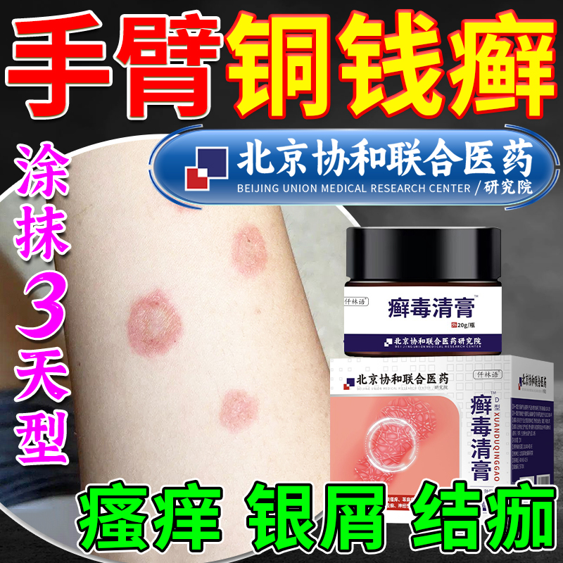铜钱癣铜钱藓皮肤瘙痒止痒抑菌杀菌专用膏正品可搭配皮癣净药膏ir