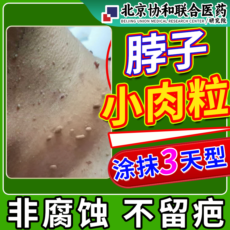 去疣去猴子肉粒疙瘩脖子上长小肉粒疣清宁疣瘊祛除可搭膏药贴ir