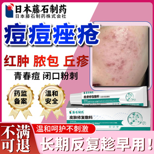 脸上痘痘痤疮反复长痘红肿硬块脓包玫瑰痤疮去下巴痘闭口粉刺膏OA