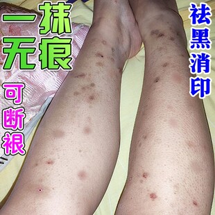 腿上挠印痘印伤烫疤痕蚊虫叮咬去黑印淡化黑色素沉淀去豆疤印消印