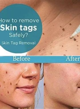 极速Tu bkill Remover Skin Mole &amp Genital Wart Corn Remove