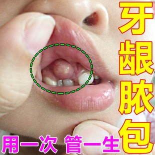 极速牙龈鼓包肿包治牙根发炎萎缩出血肿痛牙M周消除上火流脓专用