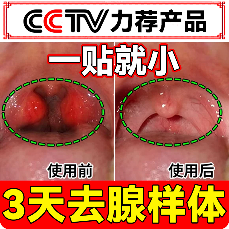 腺样体肥大中药贴儿童调理张嘴呼吸睡觉嘴唇上翘面腺样体容矫正器