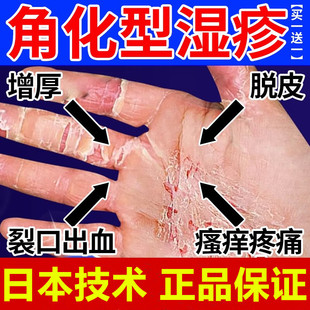 角化型湿疹手癣膏脱皮干裂真菌感染慢性角质化皲裂性手部湿疹脚部