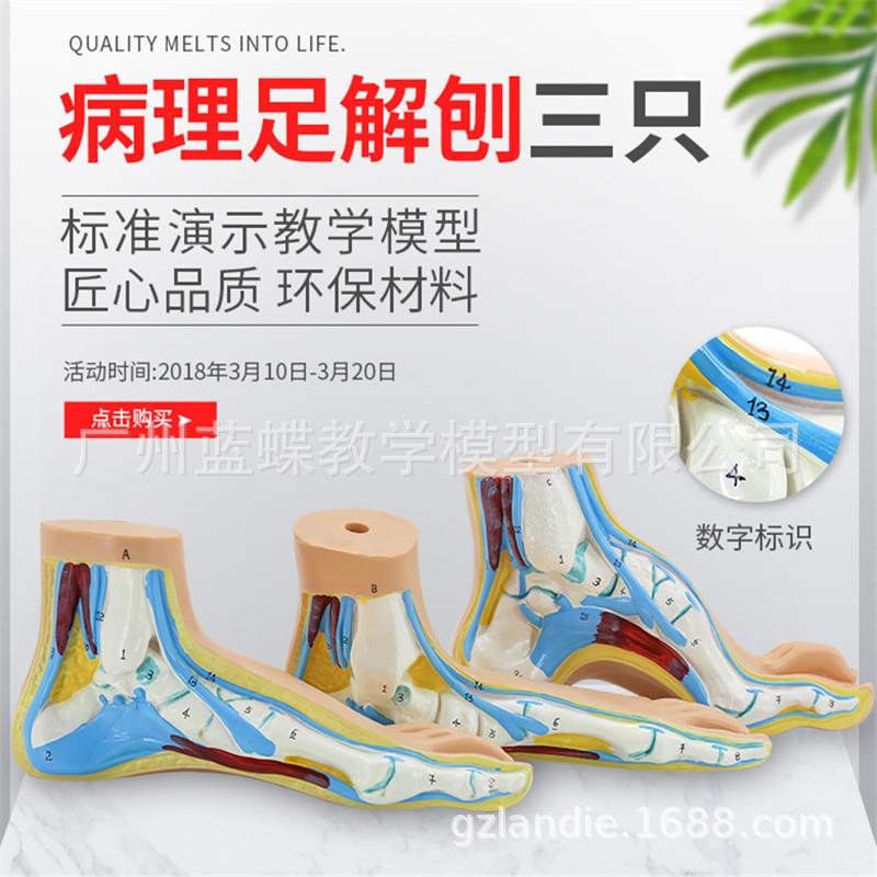 正常足、扁平足、弓形足模型/足弓模型 解剖模型 脚模型 教学模型