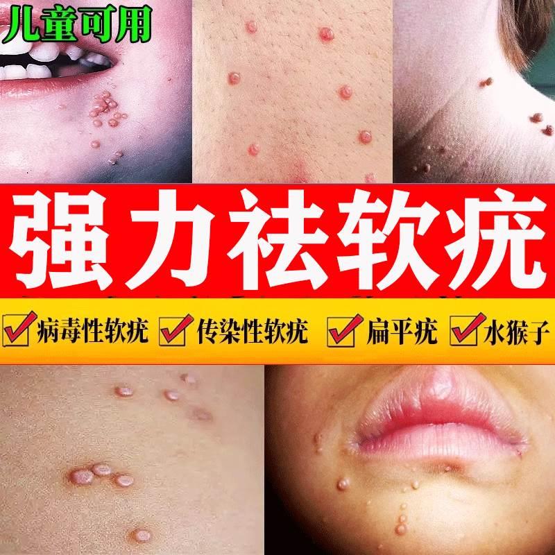 病毒性传染性软疣儿童水猴子药膏软尤医用镊子夹子刮勺去疣药水ca