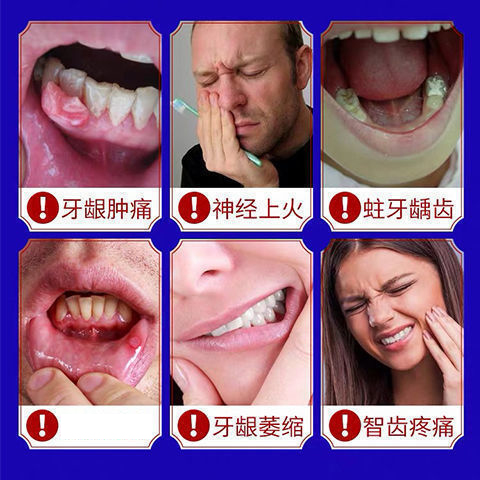 急速发货牙齿松动固定器固齿修复牢牙散固牙药护理牙齿松动牙结石