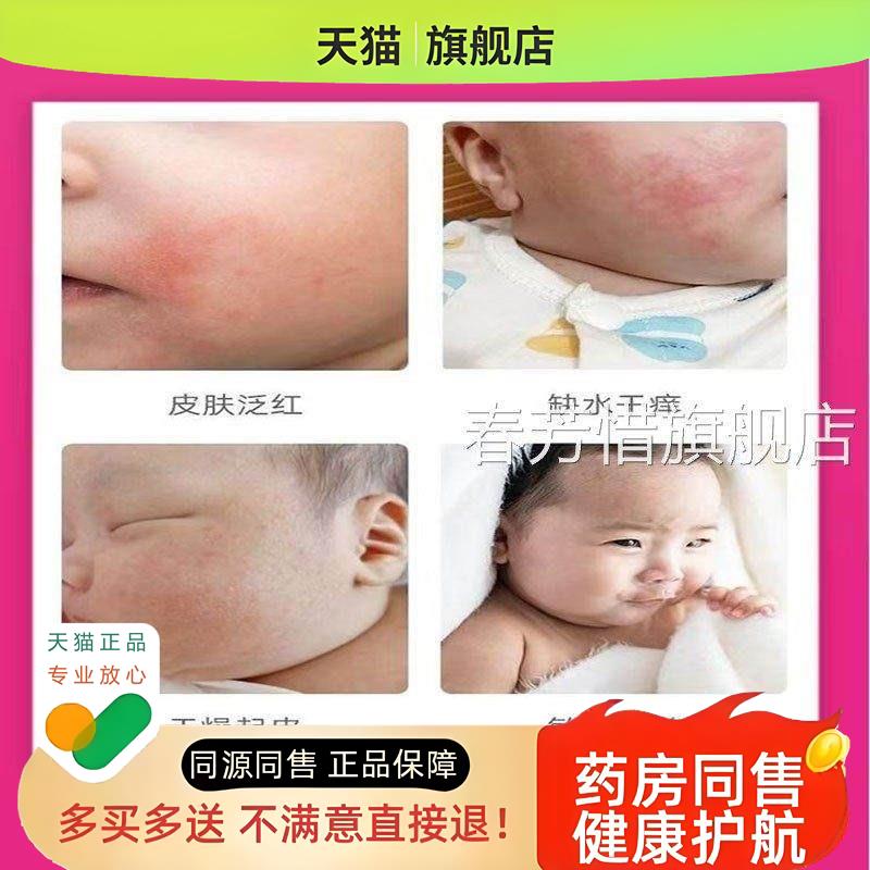 皮崔恩贝炉甘石宝宝膏部痒潮红脸脱私处红屁屁奶淹脖子