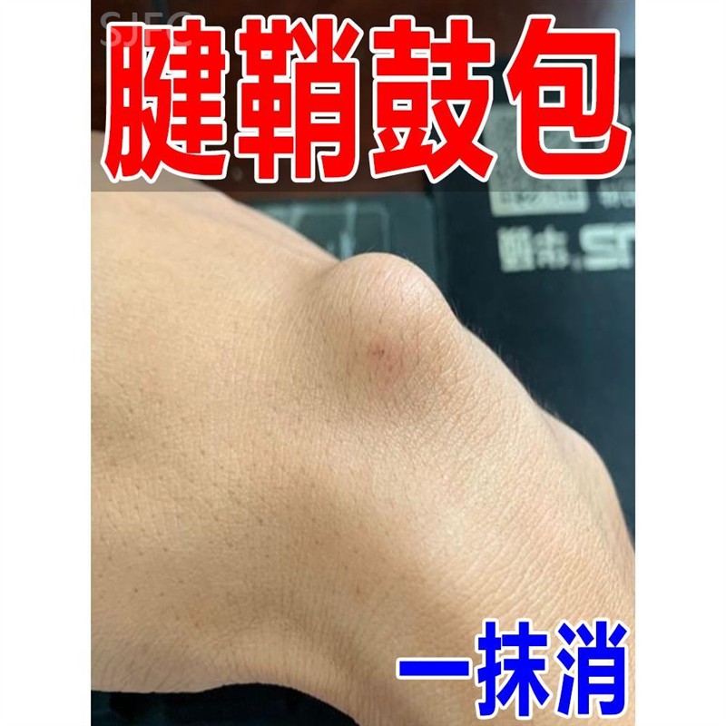专冶腱鞘焱】腱鞘肿大大拇指关节手腕疼痛肿胀止痛膏