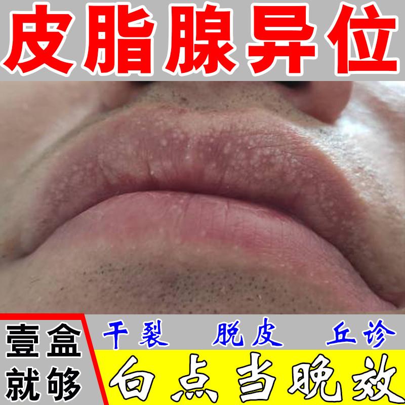皮脂腺异位嘴唇白点小颗粒唇炎专用药膏嘴唇干裂脱皮唇膜炎润唇膏