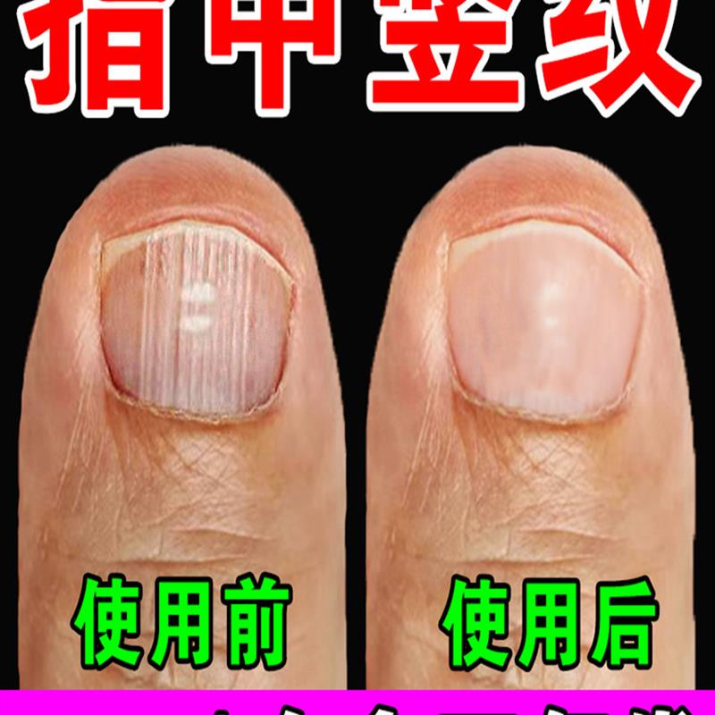 指甲竖纹修复营养精华液油甲床分离空甲修复开裂薄软生长凹凸不平