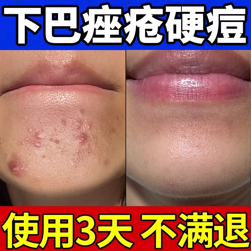 下巴反复长痘内分泌硬块痤疮淋巴腮边脸上调理疙瘩