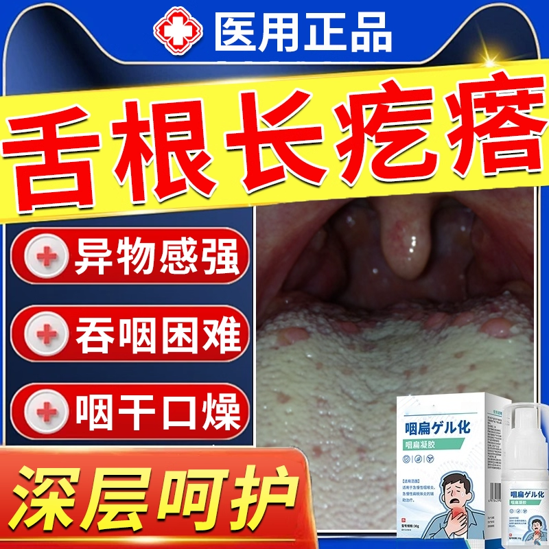 舌根长疙瘩淋巴滤泡性增生咽喉炎慢性咽炎除异物感根舌头上肉粒