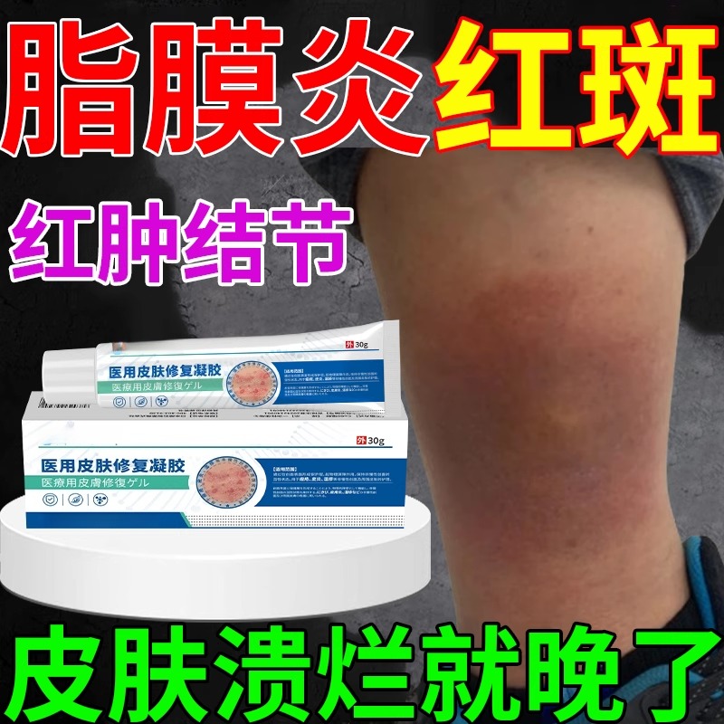 结节性脂膜炎红斑筋膜炎药房同款皮下结节软组织水肿