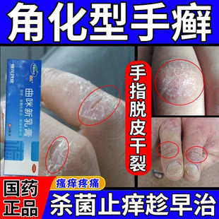 特效角化型湿疹手癣膏脱皮干裂真菌感染手掌粗糙增厚皮炎湿疹真菌