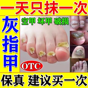 治疗灰指甲专用药亮正品旗舰店甲沟炎根真菌药膏水除非特效