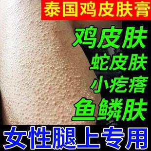 毛周角化症腿上有鸡皮肤疙瘩毛囊角化膏去除神器毛孔堵塞疏通SJ