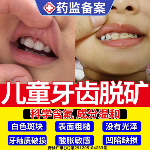 儿童牙齿脱矿专用牙膏含氟再矿化白斑钙化防蛀牙龋齿修复牙釉质TT