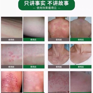 灰黄霉素软膏感染灰黄霉素外用药膏霉素软膏买2送1买送2