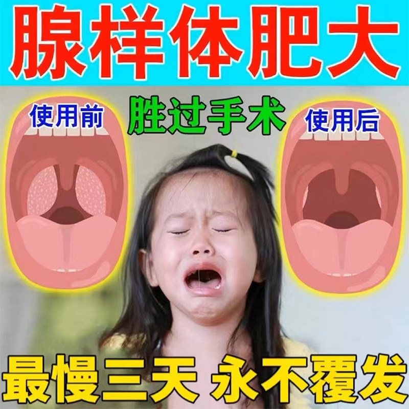 现货速发【无添加】腺样体肥大面容矫正器儿童宝宝睡觉张嘴鼻塞呼